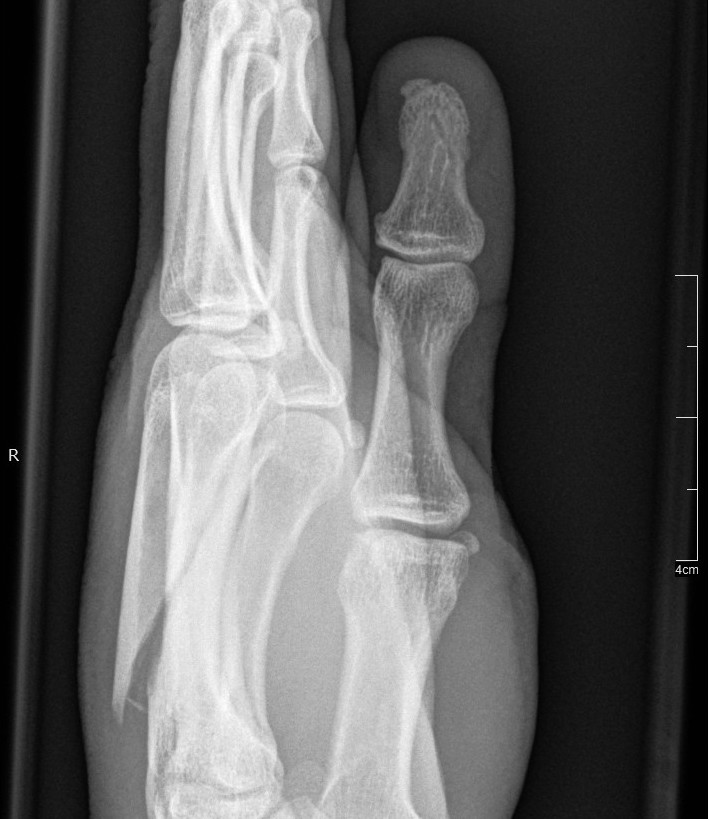 Side view of my left hand (fingers up, thumb closest to you). The spiky shard of bone bottom-left shouldn't be there!